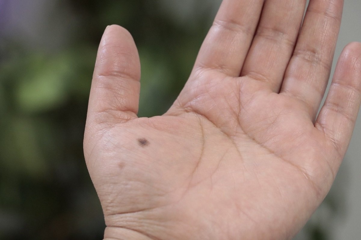 Lunares con alteraciones pueden ser cancerígenos 