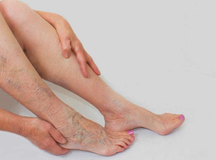 Várices afectan a 7 de cada 10 mexicanos que pasan más de 5 horas de pie o sentados